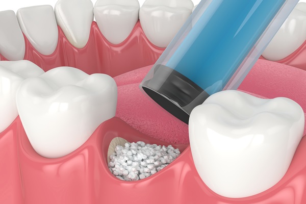 Understanding Bone Grafting: How It Restores Jawbone Health And Strength